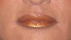 after lip augmentation female patient