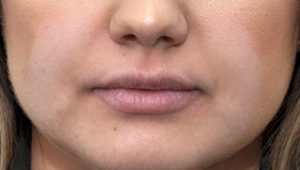 lip augmentation after treatment