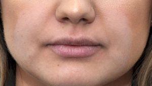 lip augmentation after treatment