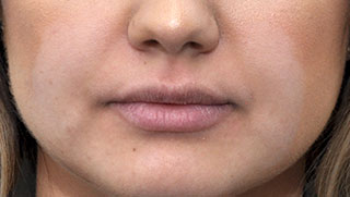 lip augmentation after treatment