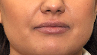lip augmentation before treatment
