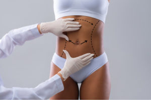A woman gets ready for skin removal following bariatric surgery.
