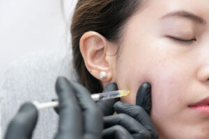 Dermal Filler Procedure.