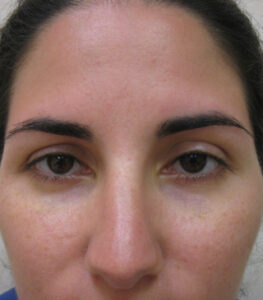 smooth forehead after Dysport