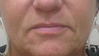 before lip augmentation female patient