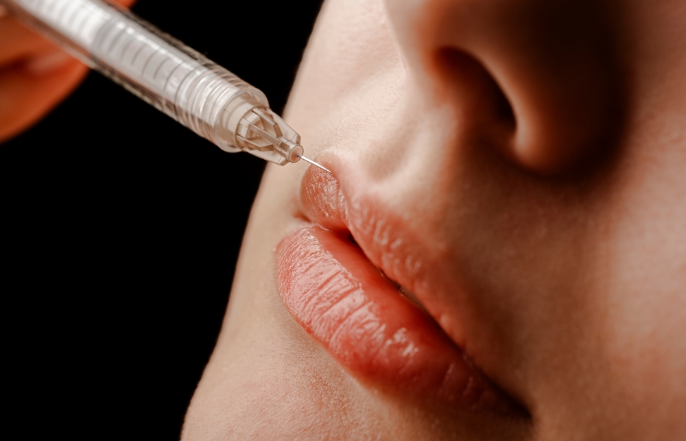 a close-up of lips getting filler touch-ups