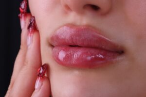a close-up of a woman's lips that have lip filler