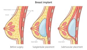a diagram showing the placement of breast implants over and under the muscle